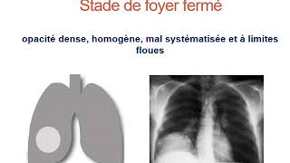 1 ABCÈS PULMONAIRE  Quatrième Année Médecine [upl. by Pricilla]