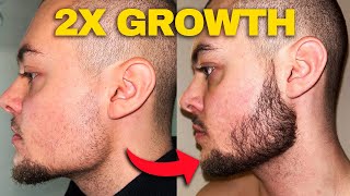 Minoxidil Beard Growth  How To Double Your Minoxidil Beard Growth Results [upl. by Allison530]