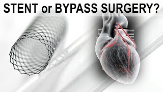 Stent or Bypass Surgery [upl. by Nwahsal]