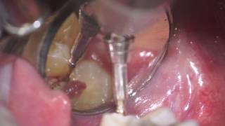 operculectomy of mx 3dr molar [upl. by Atela]