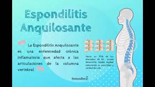 ESPONDILITIS ANQUILOSANTE CAUSAS SÍNTOMAS Y TRATAMIENTO [upl. by Elita]