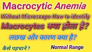 Macrocytic anemia  Microcytic anemia  Anemia in hindi [upl. by Toy]