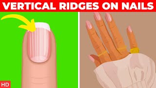 What Causes Vertical Ridges On Nails And How To Treat Them [upl. by Rodgers303]