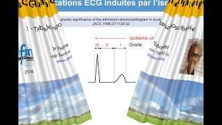 8h ECG qui annoncent la tempête 1 Ischémie aiguë et infarctus Dr Taboulet [upl. by Zashin]