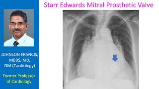 Starr Edwards Mitral Prosthetic Valve [upl. by Silverman]