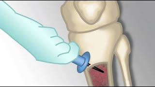 quotPlacement of an Intraosseous Linequot by Monica Kleinman MD for OPENPediatrics [upl. by Agnella172]