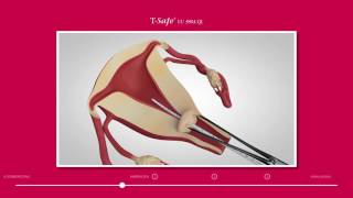 TSafe insertie instructie video [upl. by Ttereve]