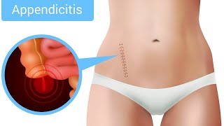 Appendicitis Symptoms Treatment  Appendicitis Pain  Health Go [upl. by Nanyt458]