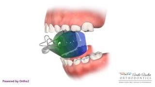 Bionator  Orthodontic Treatment  Deep Bite  Overjet [upl. by Kunz424]