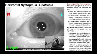 Nystagmus EXPLAINED 👀  Visualizing amp Interpretation [upl. by Natalina]