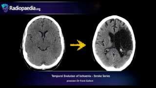 Stroke Evolution from acute to chronic infarction  radiology video tutorial CT MRI [upl. by Thurlough]