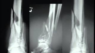 Pilon Fractures Management Options [upl. by Kolva]