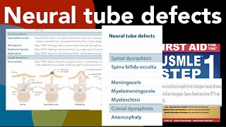 Neural tube defects Spina bifida occulta Meningocele Myelomeningocele Myeloschisis Anencephaly [upl. by Jovi]