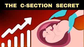 The Truth About Rising CSections  Cesarean Births [upl. by Adav594]