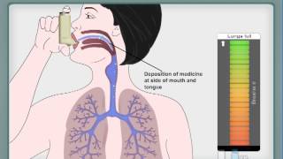 How to use Asthma inhaler  MDI [upl. by Clothilde]