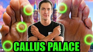 Callus Palace Cutting Out Multiple Painful Calluses [upl. by Iroc]