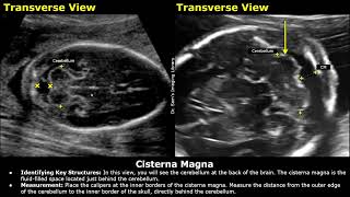 How To Measure Fetal Cisterna Magna On Ultrasound  Fetal Brain Anomaly Scan  Obstetric USG [upl. by Yeznil]