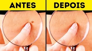 10 Maneiras Efetivas de Remover Pólipos Epiteliais Naturalmente [upl. by Aisatna575]