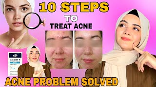 10 Basic Steps To Treat Acne  Acne Treatment At Home  Dietitian Aqsa [upl. by Vanny]