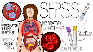 Understanding Sepsis Sepsis Explained Clearly [upl. by Bitthia349]