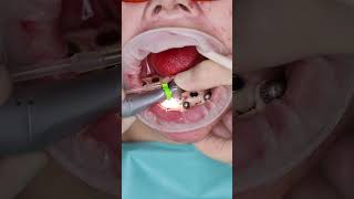 Dental implant’s All on 4 in Prague shorts dentist dental implant veneers short [upl. by Friedly]