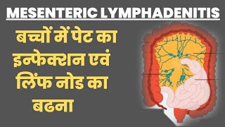 MESENTRIC LYMPHADENITIS in Hindi । बच्चों में पेट का इन्फेक्शन । लिंफ नोड का बढना [upl. by Aveneg]