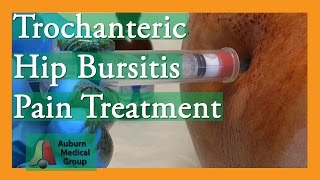 Trochanteric Hip Bursitis Pain Treatment  Auburn Medical Group [upl. by Haley]