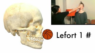 Lefort 1 Fracture  Gurein Sign  Floating Maxilla  Telescopic Fracture  Aspire MDS  Dr Bhaumik [upl. by Itsrejk]