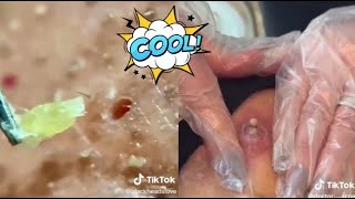 Ultimate Satisfying Acne Removal Compilation Best Pimple Pops Blackheads and Cysts [upl. by Epillihp]