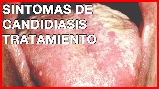 ¿Qué causa la Candidiasis Vaginal Sintomas tratamiento y fotos [upl. by Quick]