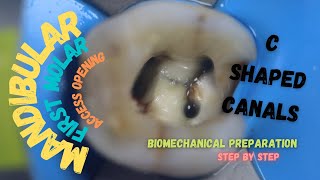 access opening in mandibular first molar with mesial caries  c shaped canals [upl. by Krystalle]