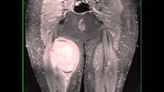 Synovial Sarcoma Thigh [upl. by Corvin]