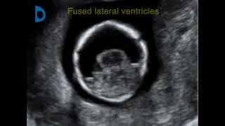 Fetal Medicine Foundation  alobar holoprosencephaly 12 weeks [upl. by Conah]