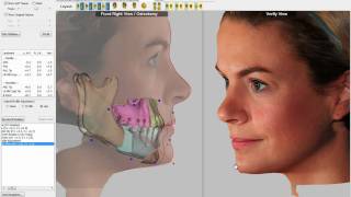 3D Visual Treatment Objective VTO Software Demo [upl. by Frodin]