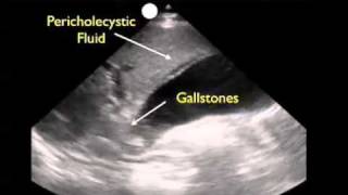 How To Gallbladder Ultrasound Part 3  Acute Cholecystitis Case Study Video [upl. by Martel]