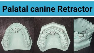 palatal canine Retractor  Canine Retractor  Easy step of Palatal canine Retractor  Orthodontist [upl. by Azilef]