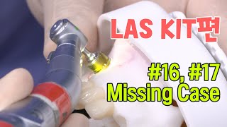 LAS KIT 16 17 Missing Case [upl. by Merrell]