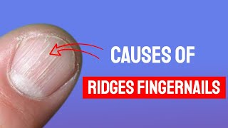 Vertical Ridges On Fingernails  What Causes Fingernail Ridges amp How to Treat [upl. by Aicirtak]