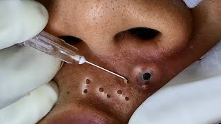 Big Cystic Acne Blackheads Extraction Blackheads amp Milia Whiteheads Removal Pimple Popping [upl. by Kwapong]