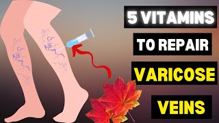 5 vitamins for venous insufficiency This is the Most Effective and Safest Remedy for Varicose Veins [upl. by Bow]