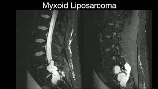 Myxoid Liposarcoma [upl. by Kramal]