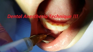 What Will Happen at Your Dental Anaesthesia Appointment [upl. by Studnia87]