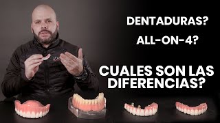 Dentaduras vs Sobre Dentaduras vs Allon4 Implantes Dentales [upl. by Glennis53]