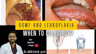 Osmf and leukoplakia when to do biopsy [upl. by Vinay73]