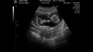 14 week ultrasound Its a Boy [upl. by Aigil]