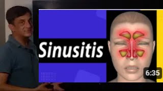 Sinusitis  Urdu  Hindi [upl. by Aluap536]