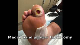 Medial Band Fasciotomy To Treat a Hallux Wound [upl. by Aicenav76]