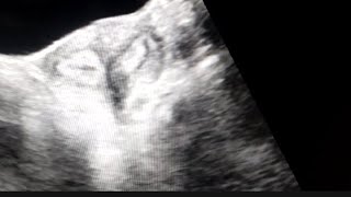 Bicornuate uterus on Ultrasound [upl. by Stanly]