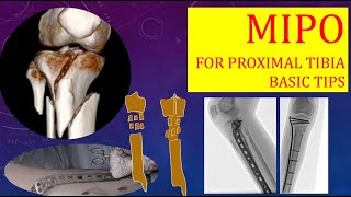 MIPO for Proximal Tibia Fractures Stepwise Basics [upl. by Fiedling]