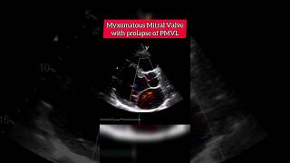 Myxomatous Mitral Valve with Prolapse of PMVL echocardiography heart [upl. by Sessler]